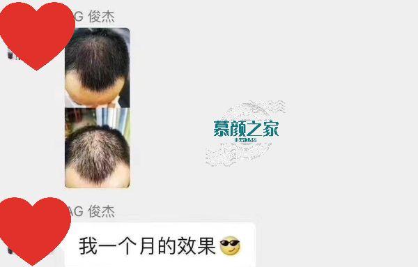 慕颜之家防脱发使用效果案例